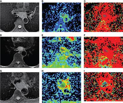 Intravoxel Incoherent Motion Model in Differentiating the Pathological Grades of Esophageal Carcinoma: Comparison of Mono-Exponential and Bi-Exponential Fit Model